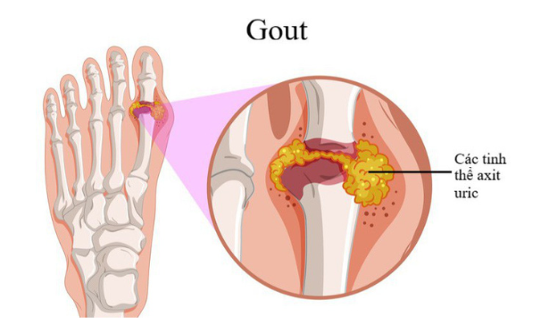 Người bị Gout thường đau nhức dữ dội ở các khớp xương. Nhân sâm tuy tốt nhưng cần thận trọng với đối tượng này