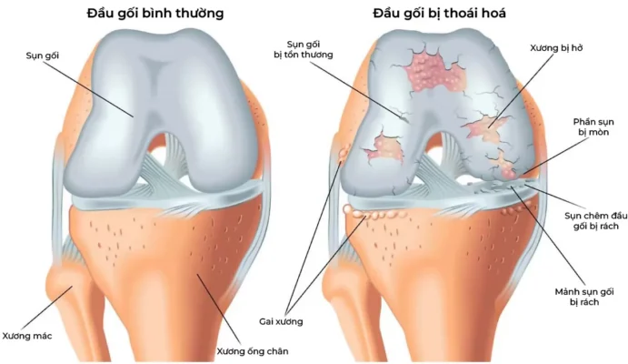 Thoái hóa khớp gây mệt mỏi đau khớp nặng