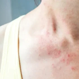 Tình trạng dị ứng thường xuyên gây báo động. Cơ thể luôn sống trong trạng thái căng thẳng.